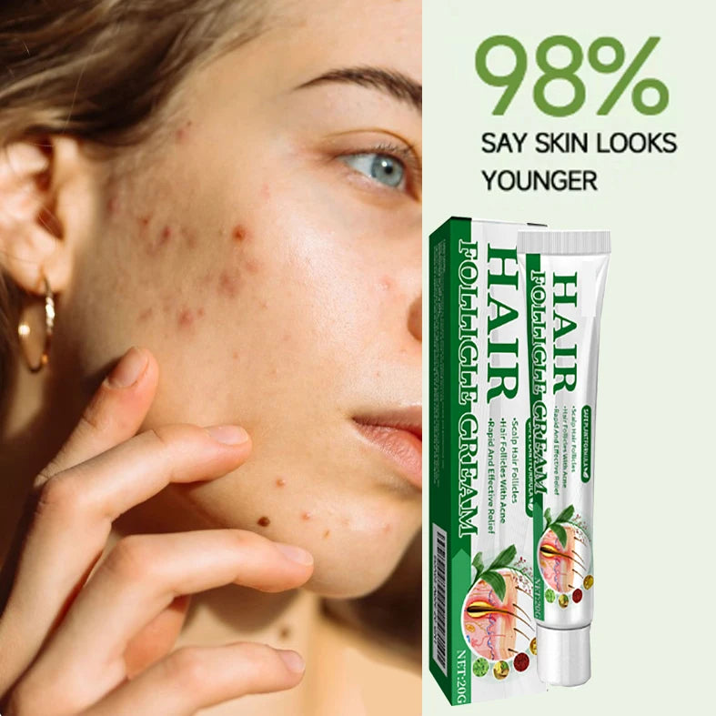 3RD Anti-Acne Cream Effective Removes Skin Nodules Pustules Cysts Papules Blackheads Men and Women Acne Skin Care Essence Cream
