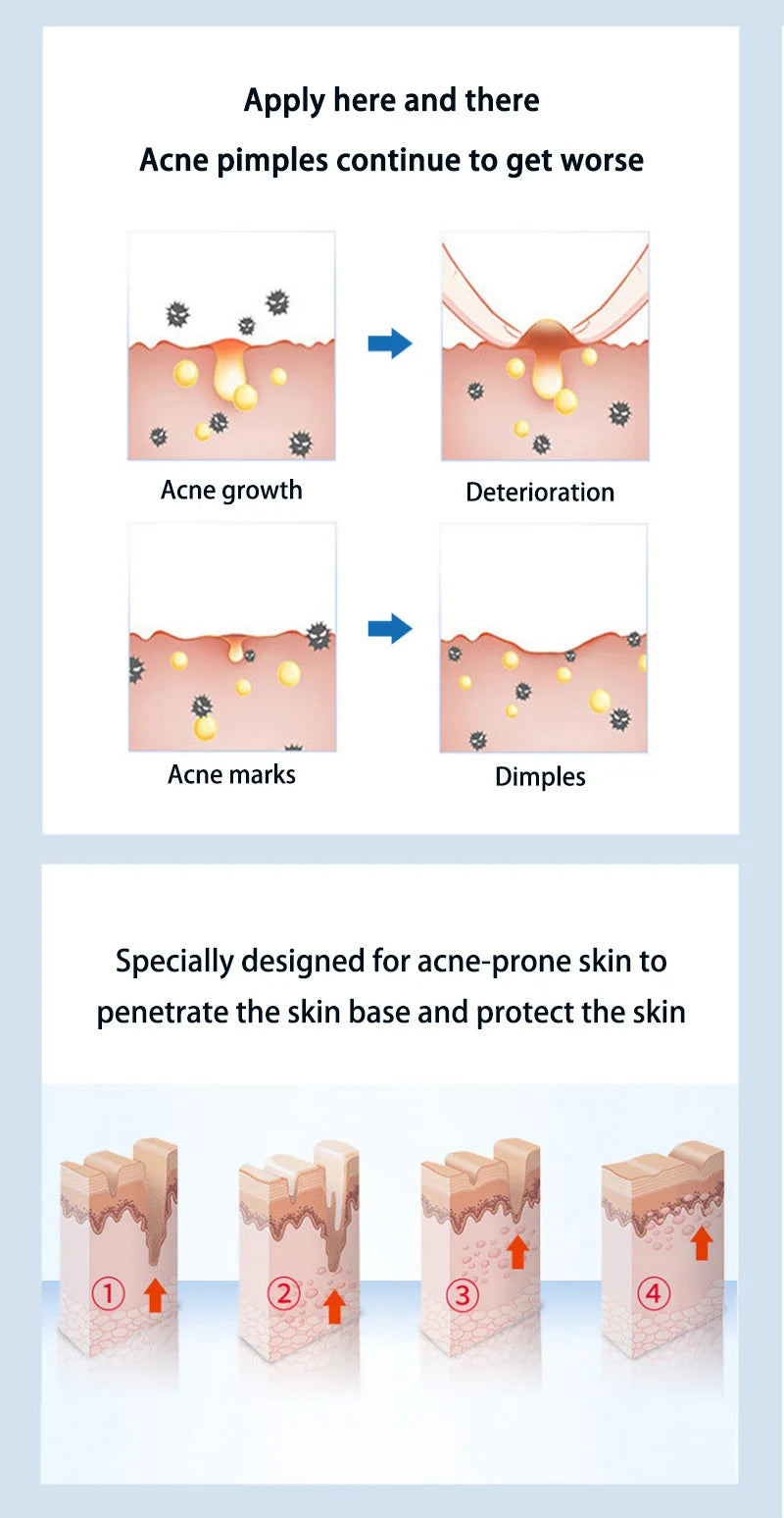 Anti-acne Treatment Cream Salicylic Acid Acne Deep Cleaning Pore Repair Pimple Spots Shrinking Oil Control Moisturizer Skin Care