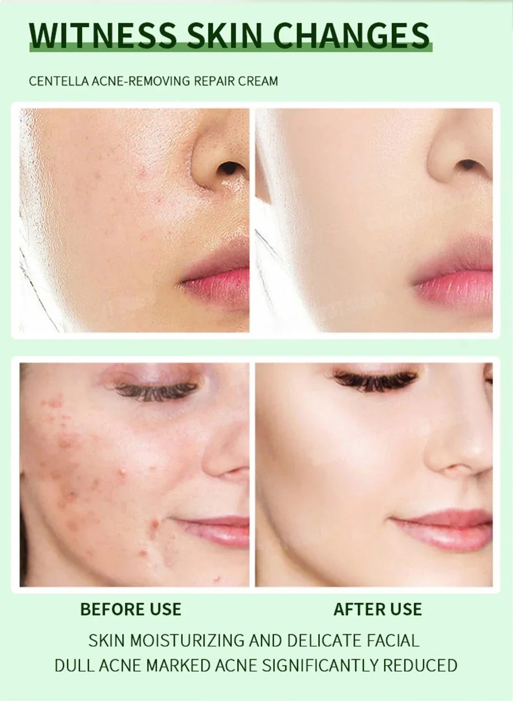 3RD Anti-Acne Cream Effective Removes Skin Nodules Pustules Cysts Papules Blackheads Men and Women Acne Skin Care Essence Cream