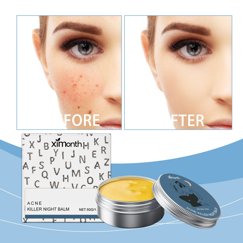 Acne Removal Face Cream Gently Balances Skin Oil Refreshing Skin Care Shrink Pores Oil Control Hydrating Anti Acne Cream