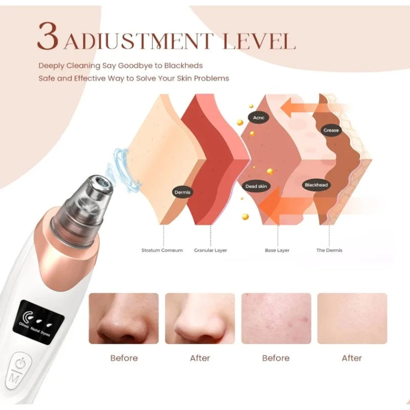 Blackhead Remover Pore Vacuum, Facial Pore Cleaner - 5 Suction Power, 5 Probes, USB Rechargeable