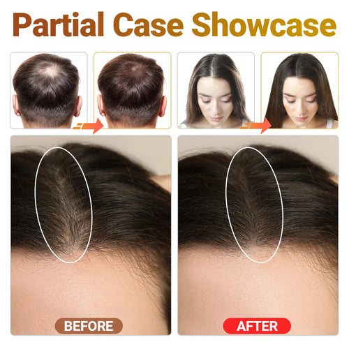 Clinical LLLT Hair Regrowth Device