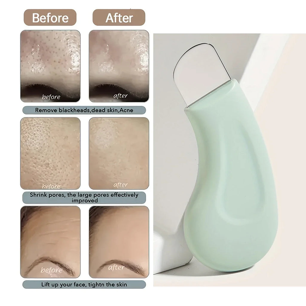 Blackhead and Whitehead Removal Tool for Nose and Face - Skin Pore Cleaner Skin Care Beauty Tools