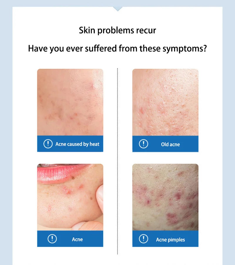 Anti-acne Treatment Cream Salicylic Acid Acne Deep Cleaning Pore Repair Pimple Spots Shrinking Oil Control Moisturizer Skin Care