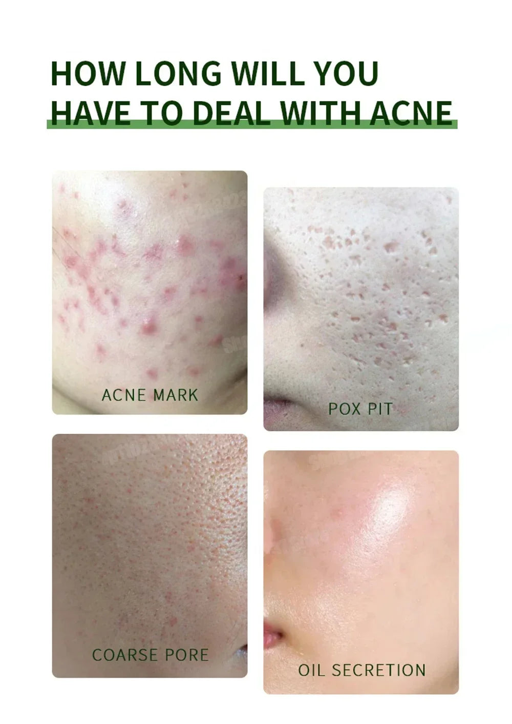 3RD Anti-Acne Cream Effective Removes Skin Nodules Pustules Cysts Papules Blackheads Men and Women Acne Skin Care Essence Cream