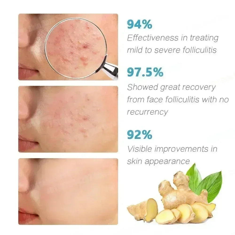 3nd Anti-Acne Cream Effective Removes Skin Nodules Pustules Cysts Papules Blackheads Men and Women Acne Skin Care Essence Cream