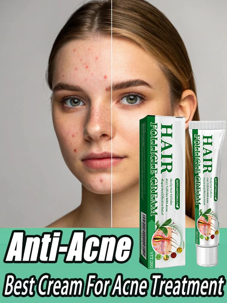 3nd Anti-Acne Cream Effective Removes Skin Nodules Pustules Cysts Papules Blackheads Men and Women Acne Skin Care Essence Cream