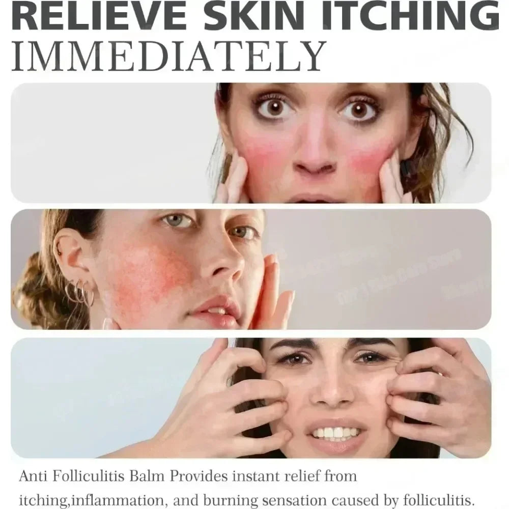 3nd Anti-Acne Cream Effective Removes Skin Nodules Pustules Cysts Papules Blackheads Men and Women Acne Skin Care Essence Cream