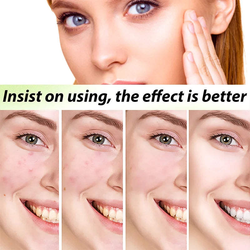 3nd Anti-Acne Cream Effective Removes Skin Nodules Pustules Cysts Papules Blackheads Men and Women Acne Skin Care Essence Cream