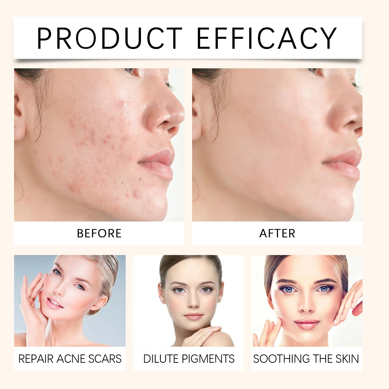 Acne Buster Salicylic Acid Lotion With Cotton Swab Set Oil Control Blackhead Remover Pore Cleanser Face Treatment Essence Serum