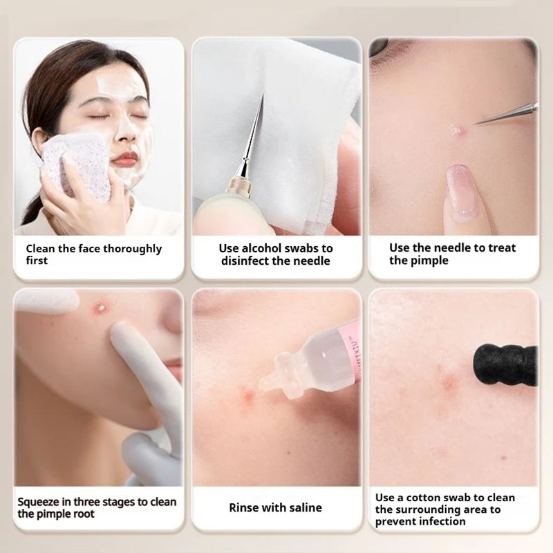 Blackhead Remover Acne Tool Stainless Steel Pore CLeaner Needles Fine Tips Effortlessly Remove Blackhead Face Deep Cleaning Tool