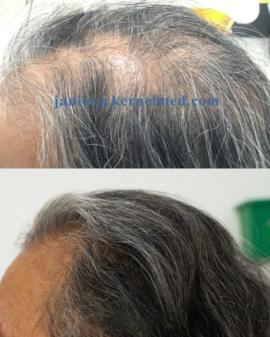 Factory Supply KN-8000B Cap Hair Growth Device Hair restoration Kernel Hair  Helmet