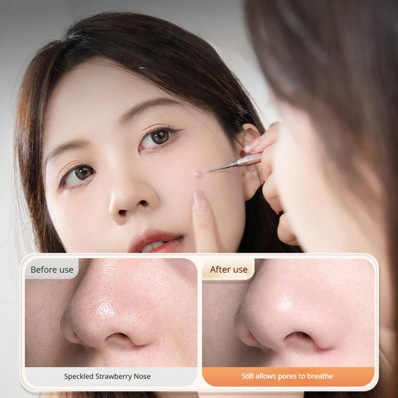 Blackhead Remover Acne Tool Stainless Steel Pore CLeaner Needles Fine Tips Effortlessly Remove Blackhead Face Deep Cleaning Tool
